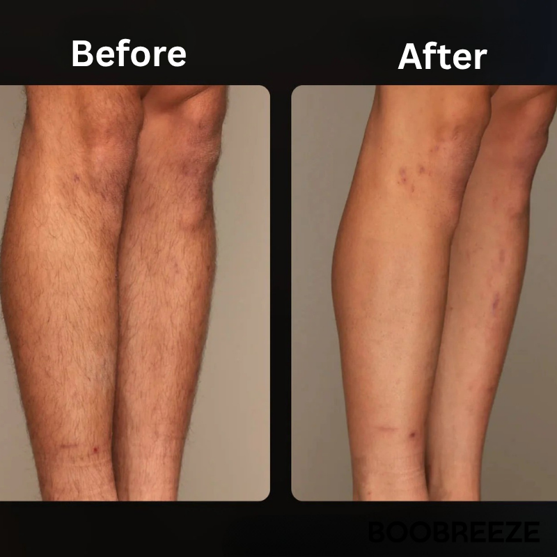 Boobreeze™ GlowTouch SkinPro Laser
