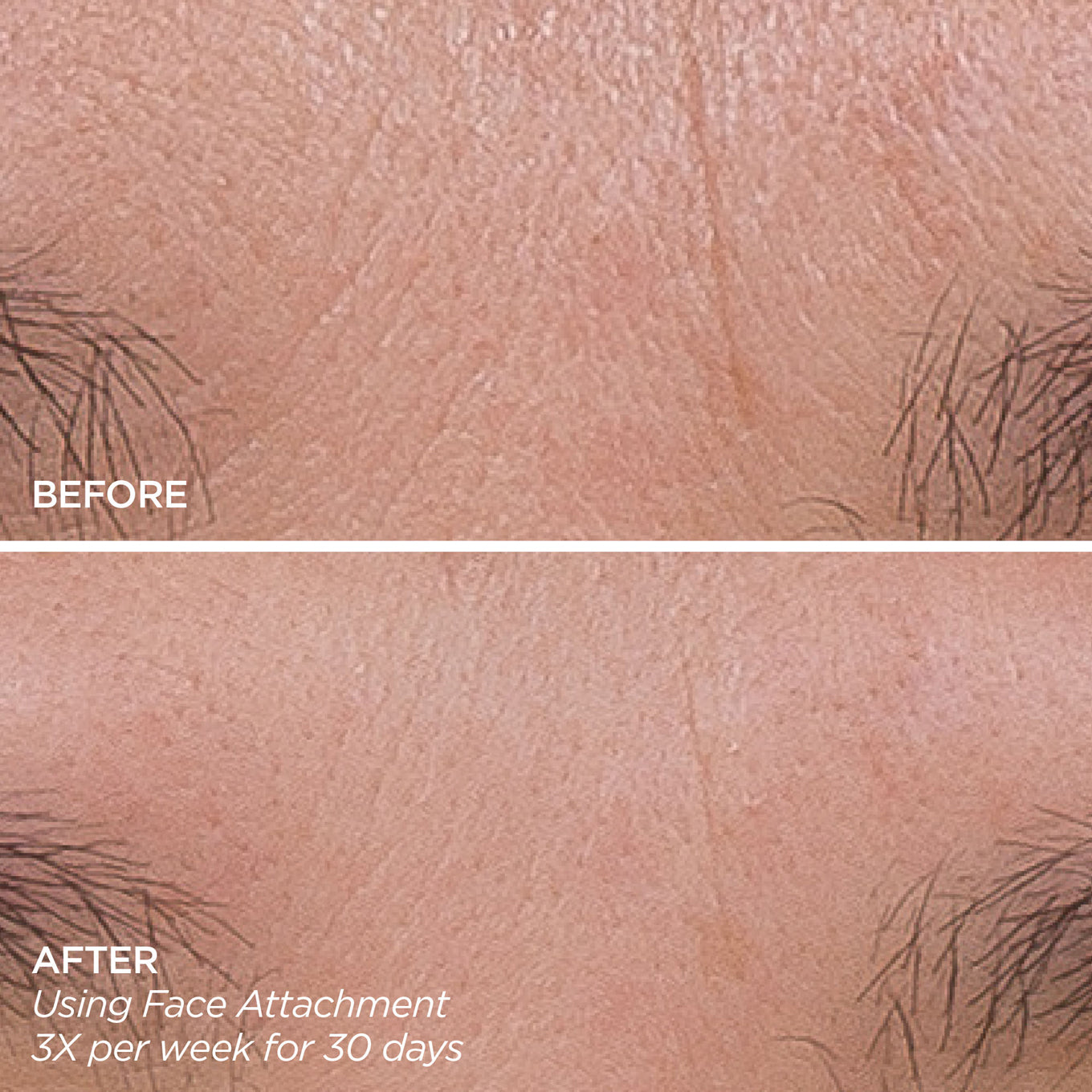 Boobreeze™ – Facial Microneedling for Fine Lines & Glow