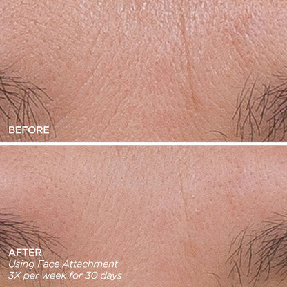 Boobreeze™ – Facial Microneedling for Fine Lines & Glow